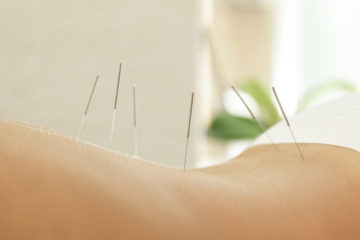 Acupuncture Therapy